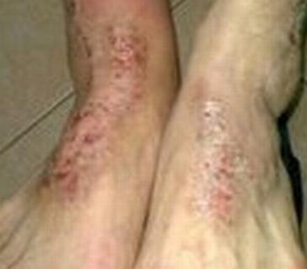 皮肌炎应怎样治疗呢"皮肌炎应怎样治疗呢"