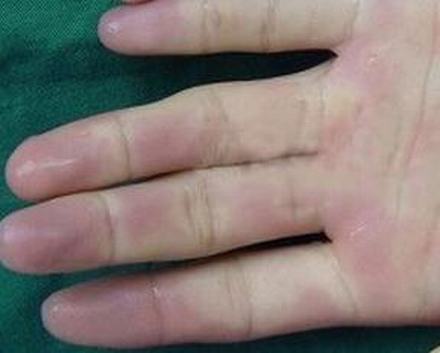 皮肌炎怎样进行鉴别