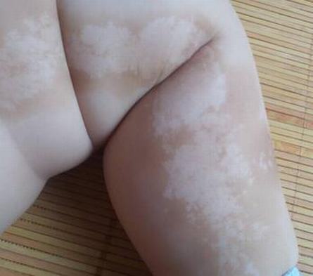 小儿皮肌炎图片