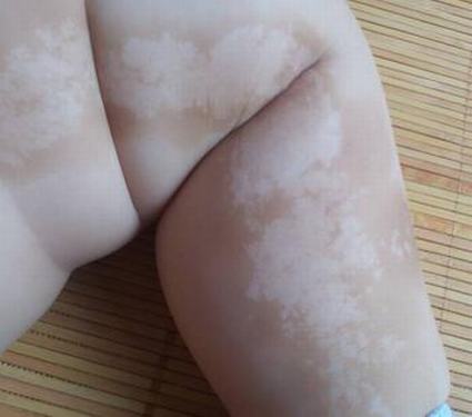 发生皮肌炎应该怎样治疗