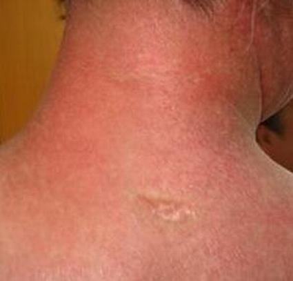 风湿性皮肌炎的症状是什么
