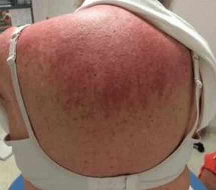 皮肌炎的肌肉损害