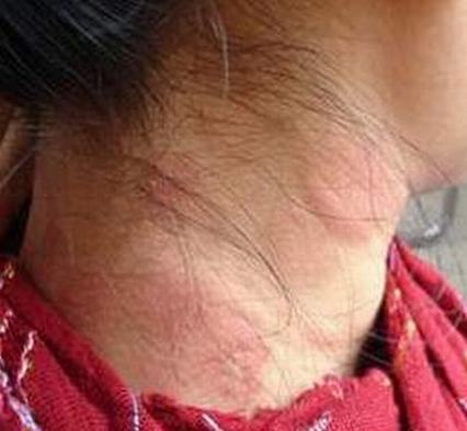 脂溢性皮炎也会导致脱发
