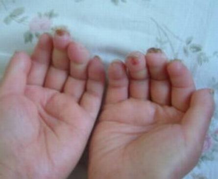 硬皮病患者该怎么进食好呢