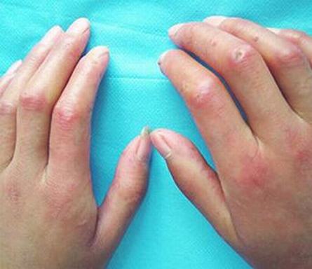 硬皮病患者发病常常隐袭,许多硬皮病病人在出现皮肤或肝脏硬化前