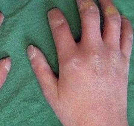 硬皮病临床上都有什么呢特点呢
