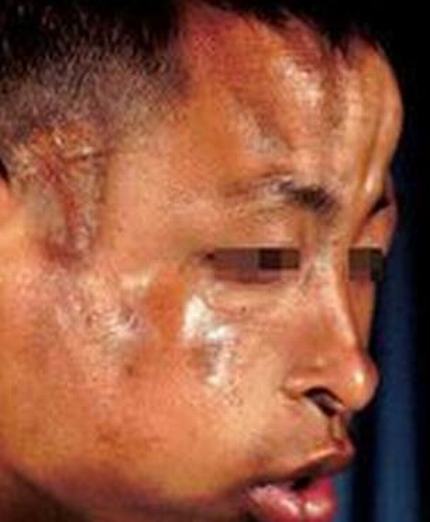 弥漫性硬皮病是什么疾病
