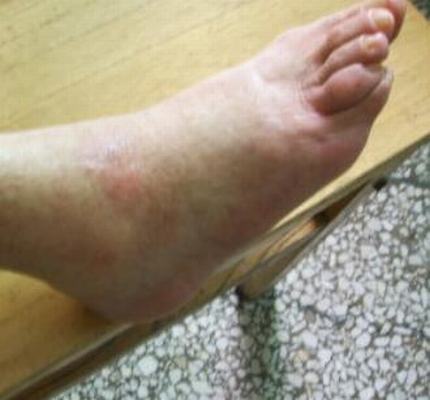 系统性硬斑病病人特别注意