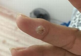 寻常疣的有效预防措施