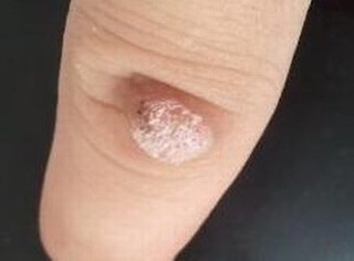 寻常疣的最佳治疗的手法是什么