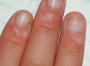 寻常疣患者要如何饮食呢