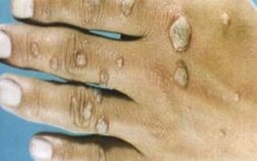 寻常疣是具会传染的皮肤病吗