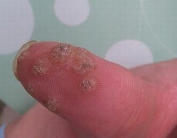 手上长鱼鳞痣怎么办