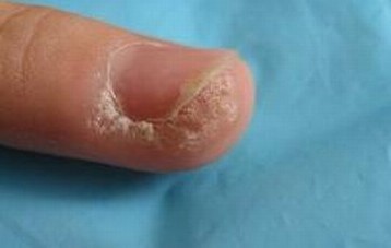 寻常疣的临床症状及特殊类型