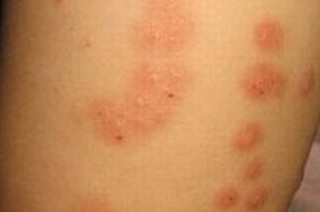 治疗慢性荨麻疹复发率低
