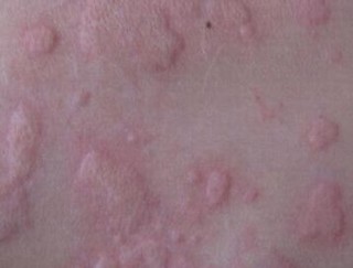 治疗急性荨麻疹过程中该如何加以防范