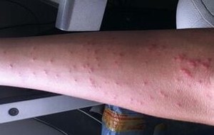 治疗丘疹性荨麻疹好的医院
