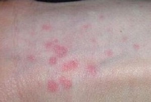 怎样的预防秋季荨麻疹