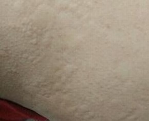 怎么治疗荨麻疹效果好