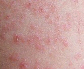 造成荨麻疹的病因有什么