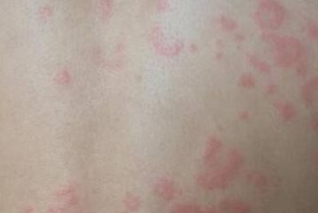 中医辨证治疗胆碱能性荨麻疹