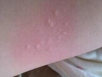荨麻疹的特点的明显的风团症状和瘙痒症状,患者经常是叫苦不堪.