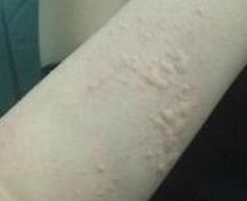 最好慢性荨麻疹治疗的手法