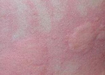 治疗荨麻疹医院哪家好疗效如何