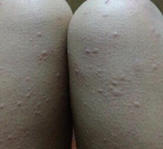 治疗荨麻疹的药物