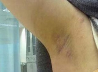 治疗腋臭需要多少钱呢