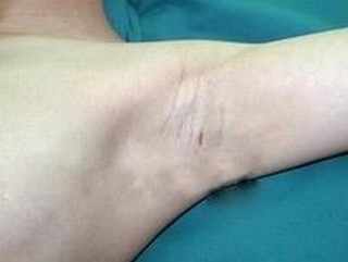 治疗腋臭去医院应该挂什么科