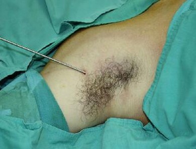 韩式微创大汗腺清除术治疗腋臭案例