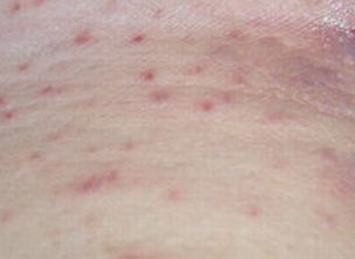 尖锐湿疣会通过皮肤损伤传染吗