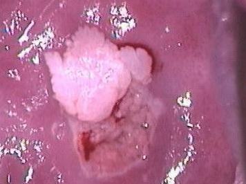 尖锐湿疣可引发宫颈癌
