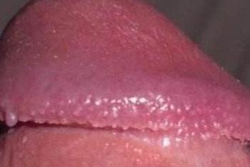 尖锐湿疣的危害性