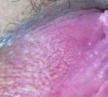 尖锐湿疣的症状是怎样