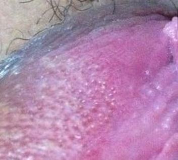 尖锐湿疣对生育能力有哪些影响