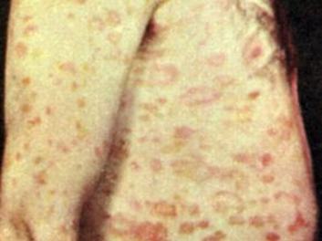 玫瑰糠疹是什么原因会致使