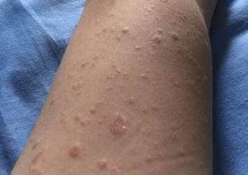 玫瑰糠疹特点有什么表现呢