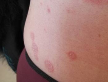 玫瑰糠疹的主要症状都是什么