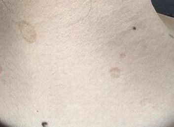玫瑰糠疹是如何导致的