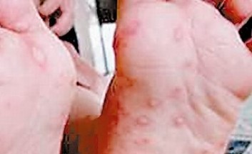 单纯性疱疹日常护理的措施
