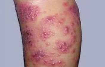 单纯性疱疹有什么损害