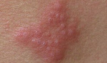 导致患上疱疹的原因具体是哪些