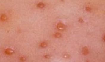 儿童单纯疱疹的表现