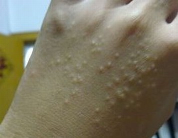 疱疹的常见症状有哪些