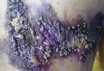 疱疹患者生活中应该注意哪些