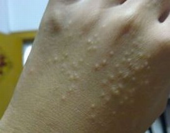 病毒性疱疹的正确