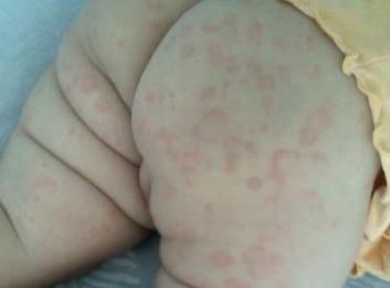 各类皮肤过敏有什么损害