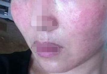 化妆品引起的面部皮肤过敏症状有哪些 